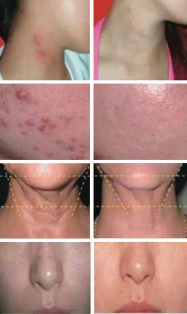 DERMA-LIGHT: Hochpräzise LED-Lichttherapie - 4