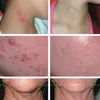 DERMA-LIGHT: Hochpräzise LED-Lichttherapie - 4