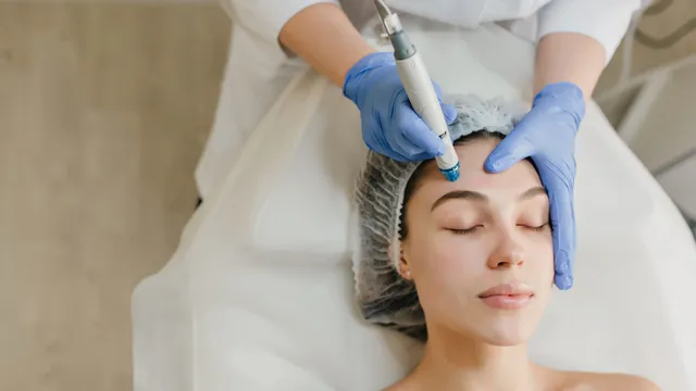 Os benefícios do Microneedling para uma pele radiante e luminosa: O que diz a ciência