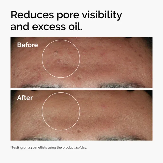 THE ORDINARY Niacinamide 10% + Zinc 1%: Face Serum | 60 ml - 2